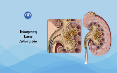 Εύκαμπτη Laser Λιθοτριψία
